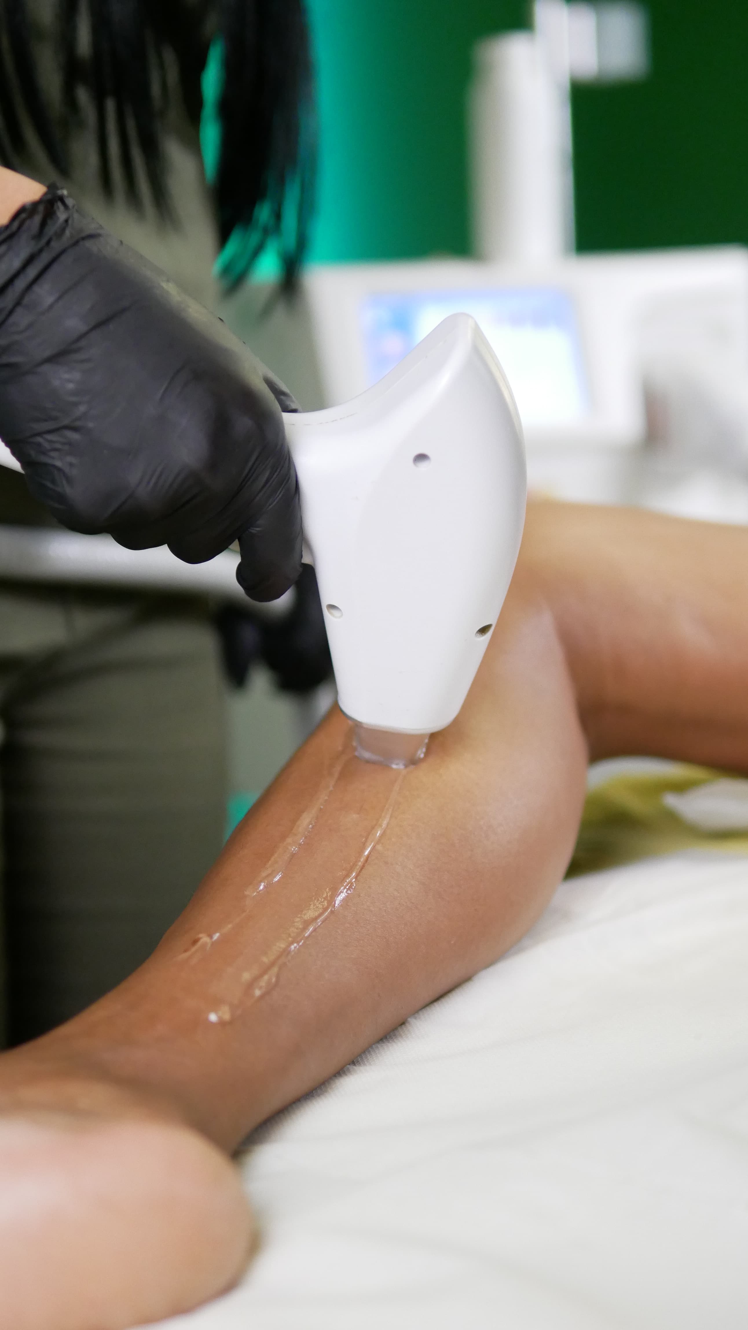 Epilazione Laser